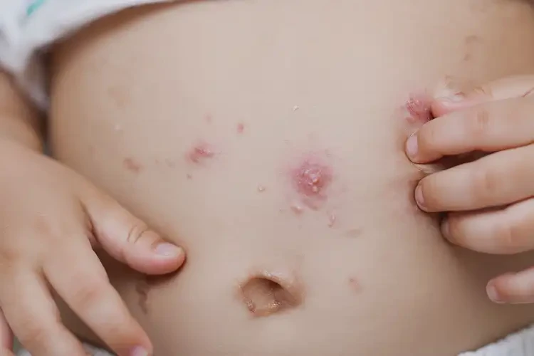 小兒肚子上偶爾起濕疹能夠徹底治愈嗎(圖4)