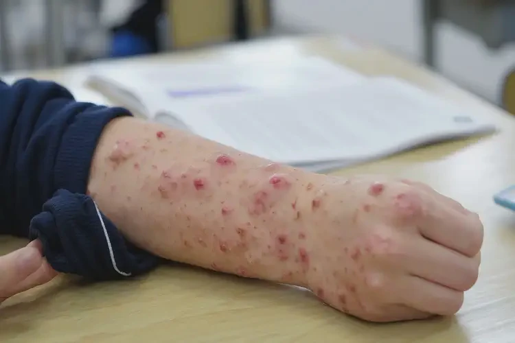 中學生手臂起濕疹可以徹底自愈嗎(圖4)