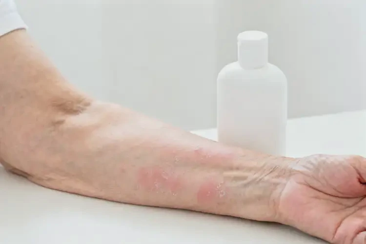 老年人手臂上容易长湿疹不管它会自己好吗(图1)