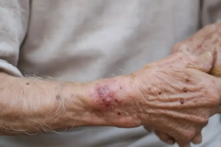 高齡老人手臂長濕疹可不可以徹底自愈(圖4)