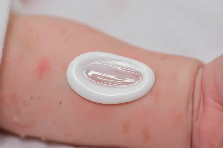 新生兒手臂上容易長(zhǎng)濕疹能靠自己自愈嗎(圖3)