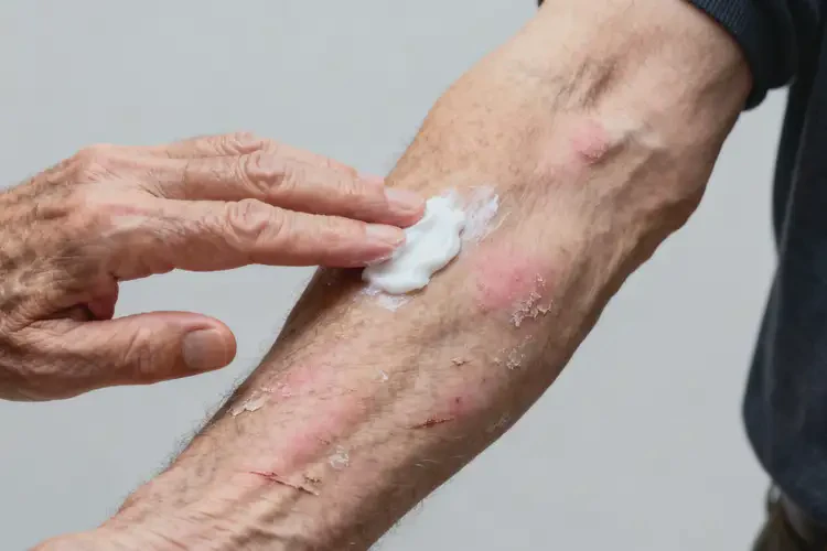 老年人手臂上出現(xiàn)濕疹不管它會自己自愈嗎(圖4)