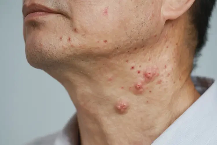 男人脖子起濕疹不管它會自己自愈嗎(圖4)