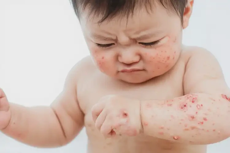 嬰兒全身容易長濕疹可不可以徹底自愈(圖4)
