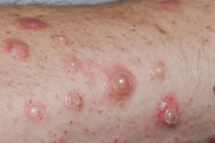 男性身上經(jīng)常長濕疹能夠徹底治愈嗎(圖4)