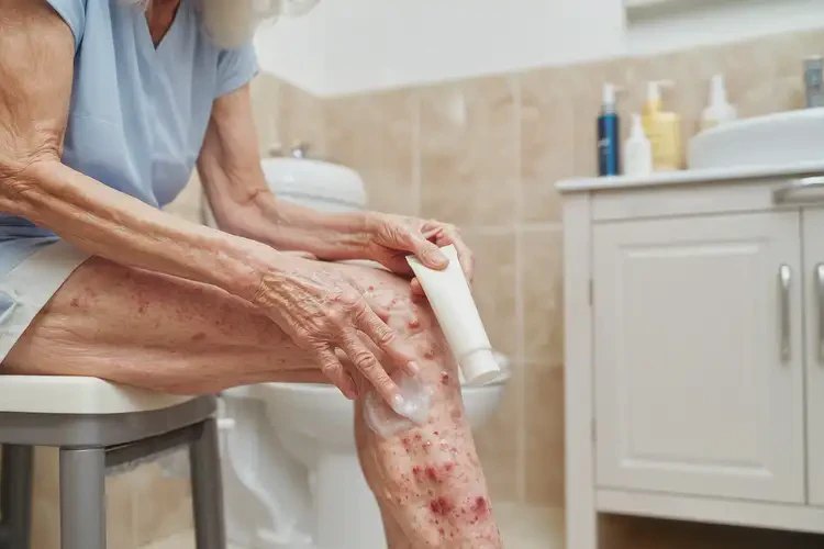 老人小腿經(jīng)常起濕疹能徹底自愈嗎(圖3)