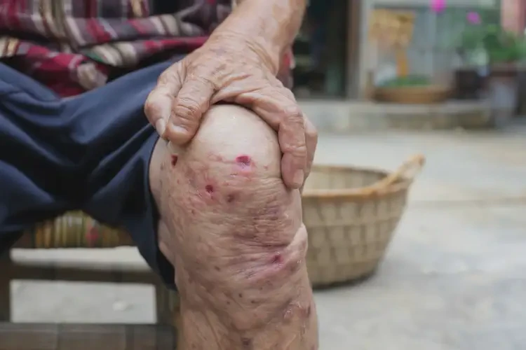 高齡老人小腿上出濕疹能徹底自愈嗎(圖4)
