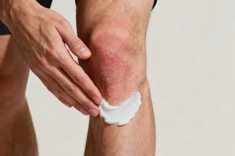 男生小腿經(jīng)常起濕疹能夠徹底治愈嗎(圖1)