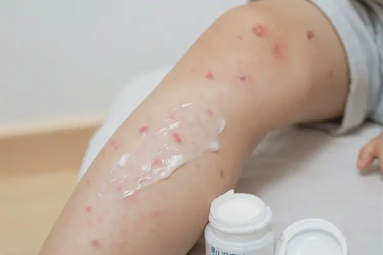 兒童小腿上有濕疹不管它會(huì)自己痊愈嗎(圖1)