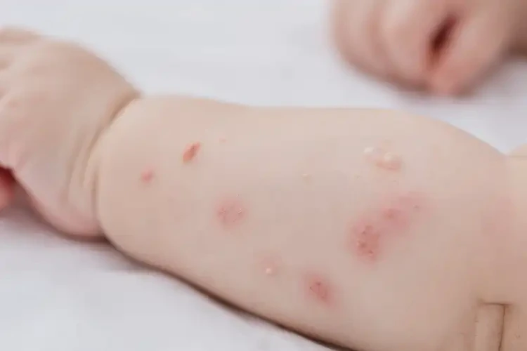 嬰幼兒手臂偶爾長(zhǎng)濕疹能夠徹底治愈嗎(圖4)