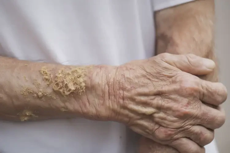 高齡老人手臂上經(jīng)常長濕疹能夠徹底治愈嗎(圖4)