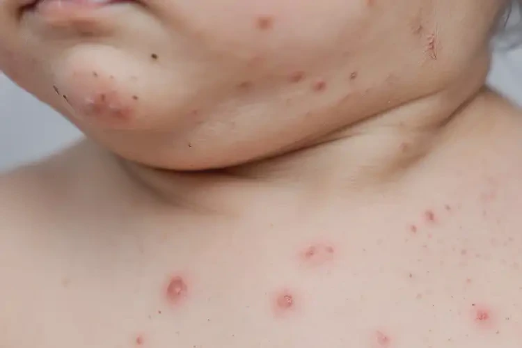 幼儿脖子上有湿疹不管它会自己自愈吗(图4)