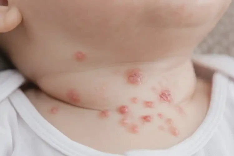 嬰兒脖子上經(jīng)常起濕疹不管它會(huì)自己好嗎(圖4)