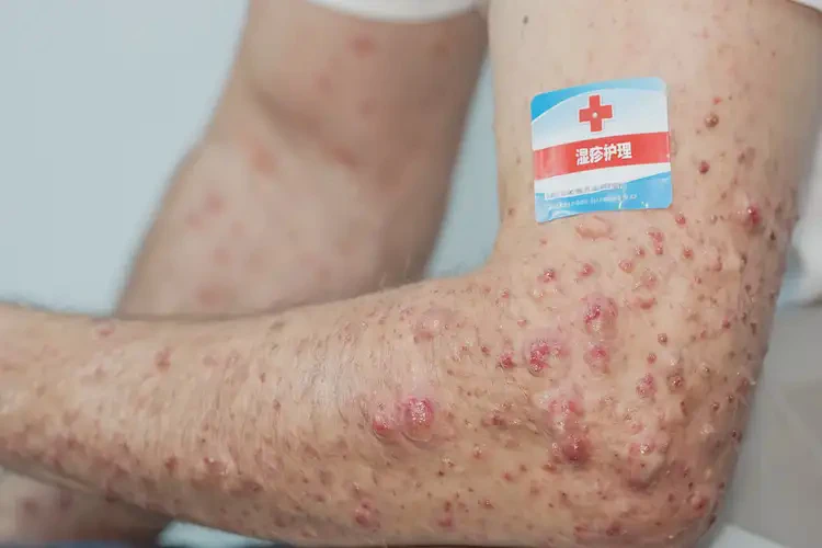 男人全身出濕疹能徹底自愈嗎(圖4)