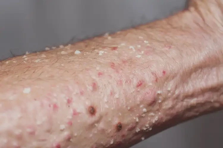 老人手臂出現(xiàn)濕疹能夠徹底治愈嗎(圖4)