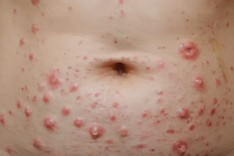 女人肚子上長濕疹不管它會自己好嗎(圖4)