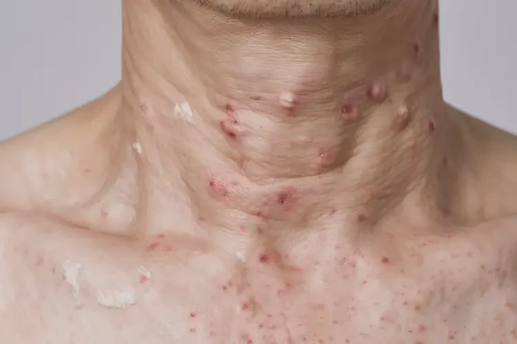 男人脖子上出现湿疹能彻底自愈吗(图4)