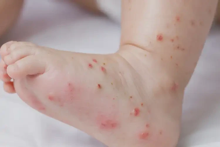 幼兒腳上經(jīng)常長濕疹能徹底自愈嗎(圖4)