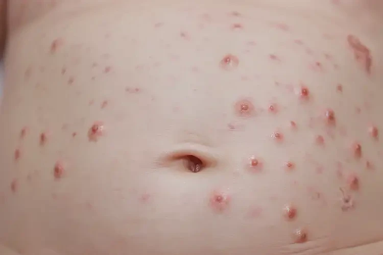 新生兒肚子上偶爾長(zhǎng)濕疹能夠徹底治愈嗎(圖4)