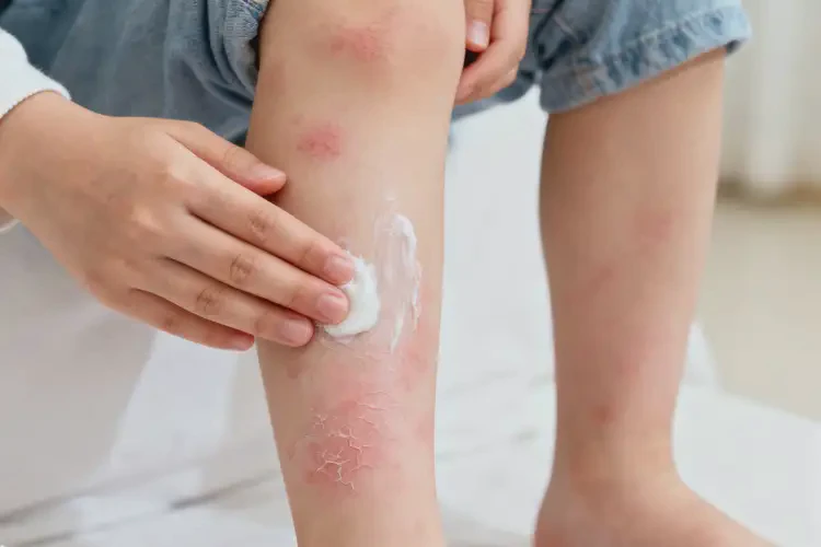 少兒小腿上有濕疹不管它會(huì)自己自愈嗎(圖2)