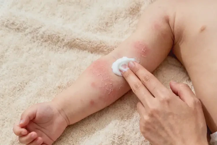 新生兒手臂上經(jīng)常起濕疹能徹底自愈嗎(圖1)