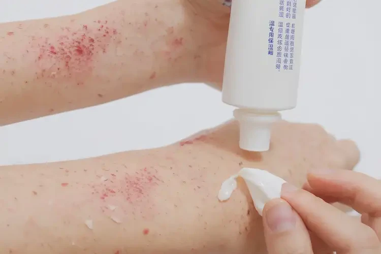 女人手臂上起濕疹能徹底自愈嗎(圖3)