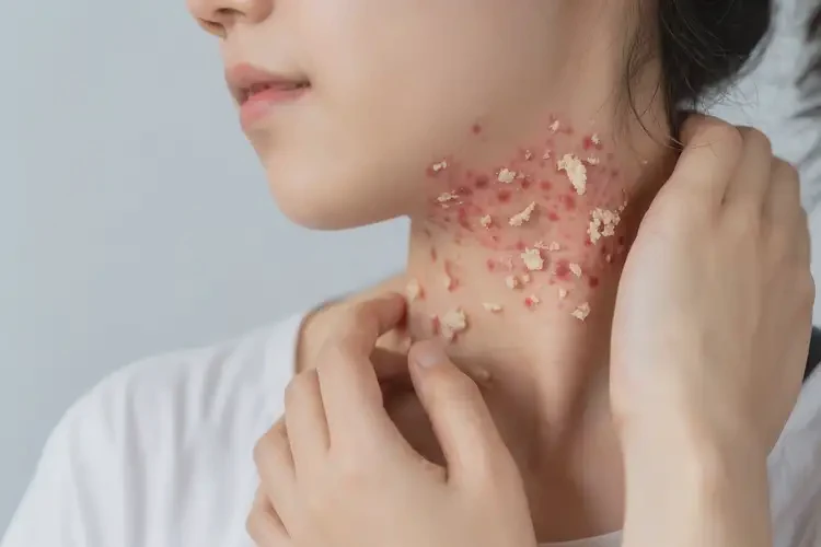 女人脖子上出濕疹不管它會自己痊愈嗎(圖4)