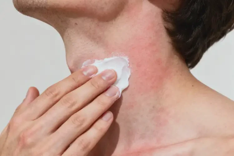 男性脖子偶爾起濕疹可以徹底自愈嗎(圖1)