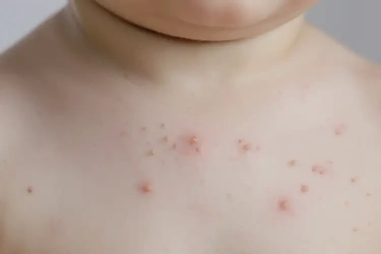 幼兒脖子上偶爾起濕疹不管它會自己自愈嗎(圖4)