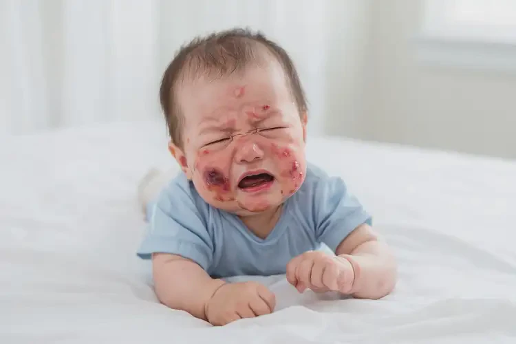 寶寶脖子起濕疹不管它會(huì)自己好嗎(圖3)