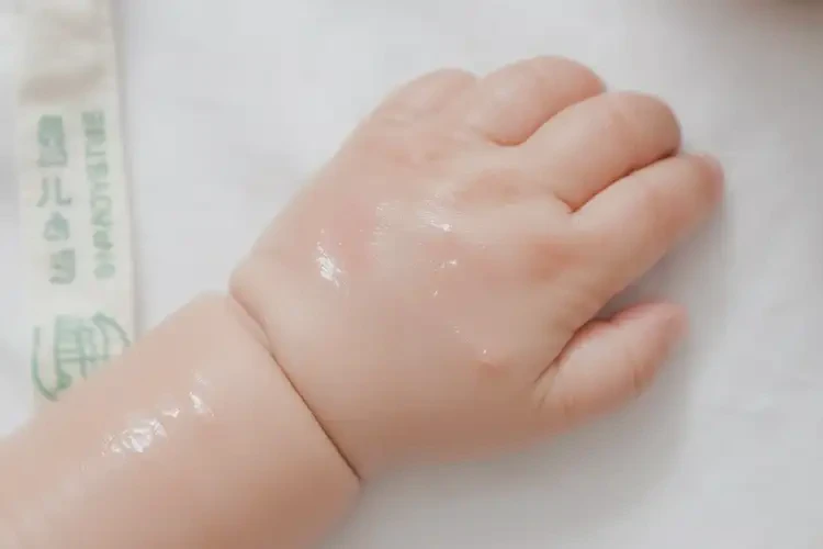 寶寶手上有濕疹不管它會自己痊愈嗎(圖3)