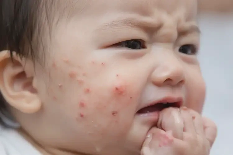 婴儿面部偶尔起湿疹能够彻底治愈吗(图4)