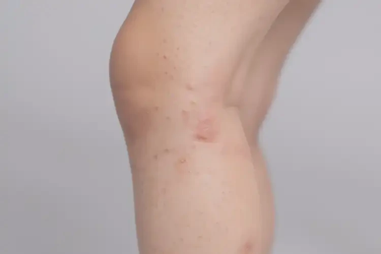 儿童大腿上偶尔起湿疹能靠自己自愈吗(图3)