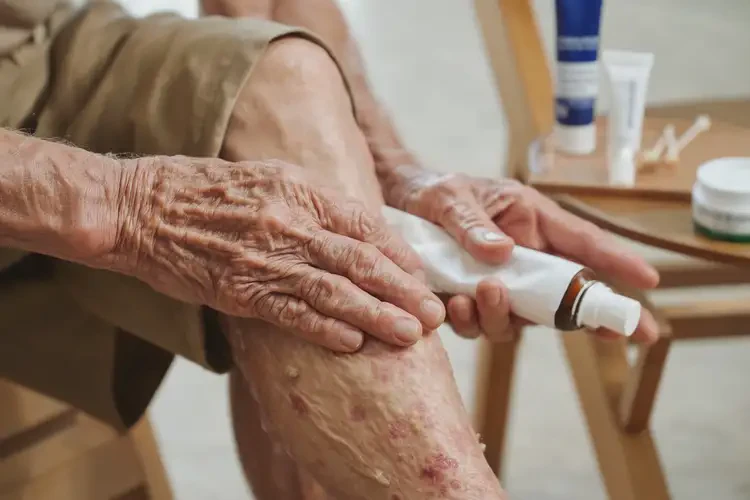 高齡老人小腿上出濕疹能徹底自愈嗎(圖3)