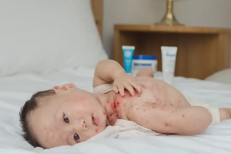 寶寶脖子出濕疹能夠徹底治愈嗎(圖4)