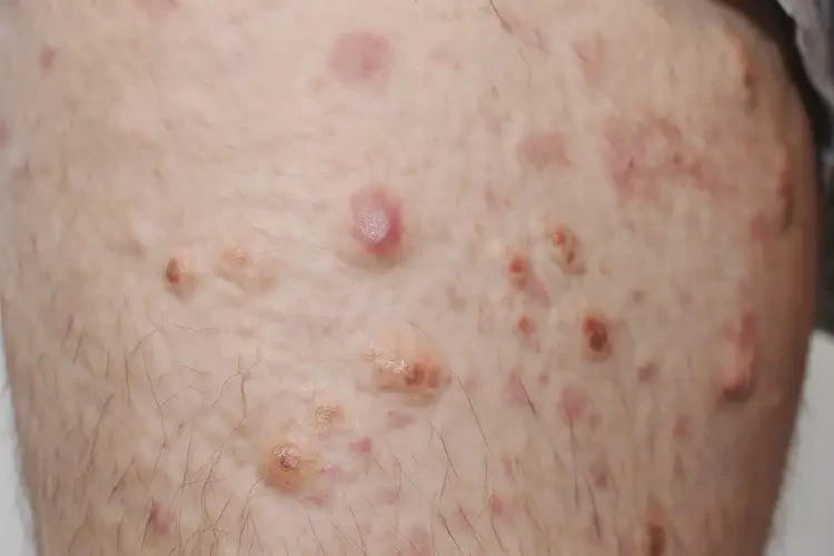 男生大腿上偶爾長濕疹可不可以徹底自愈(圖4)