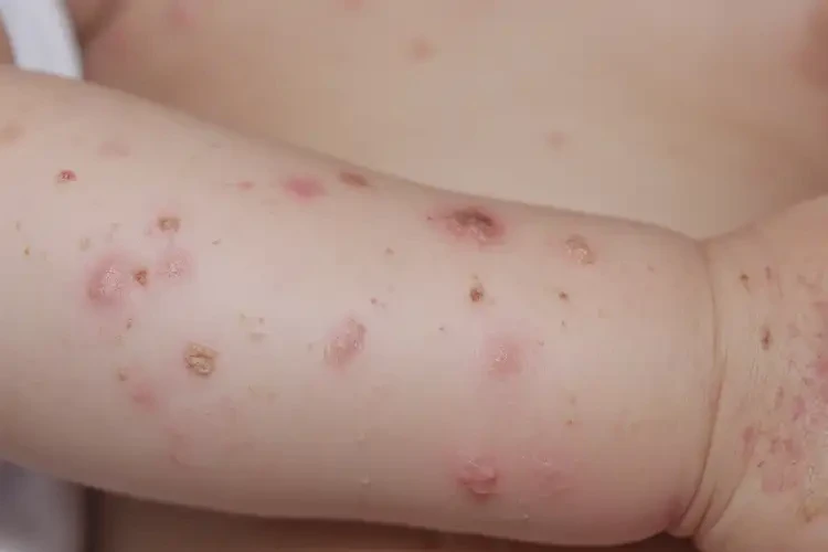 幼兒手臂有濕疹不管它會自己好嗎(圖3)