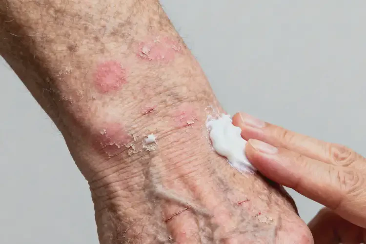 老年人手臂上出現(xiàn)濕疹不管它會自己自愈嗎(圖2)