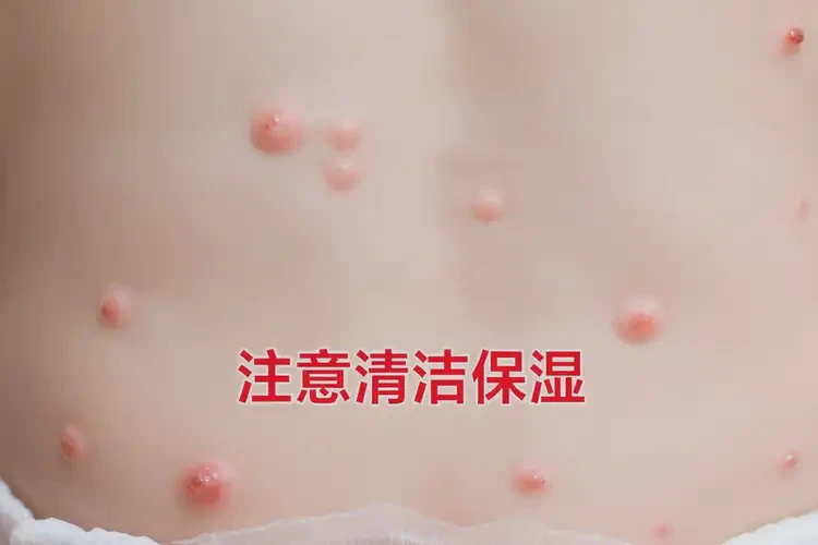 少兒屁股經(jīng)常起濕疹不管它會(huì)自己好嗎(圖4)