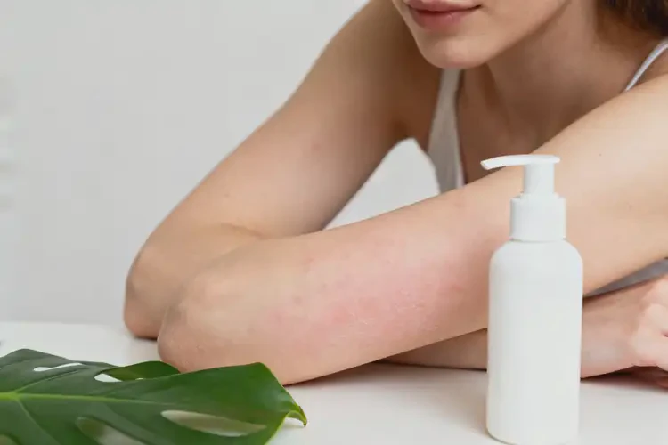 產(chǎn)婦手臂經(jīng)常長濕疹能徹底自愈嗎(圖3)