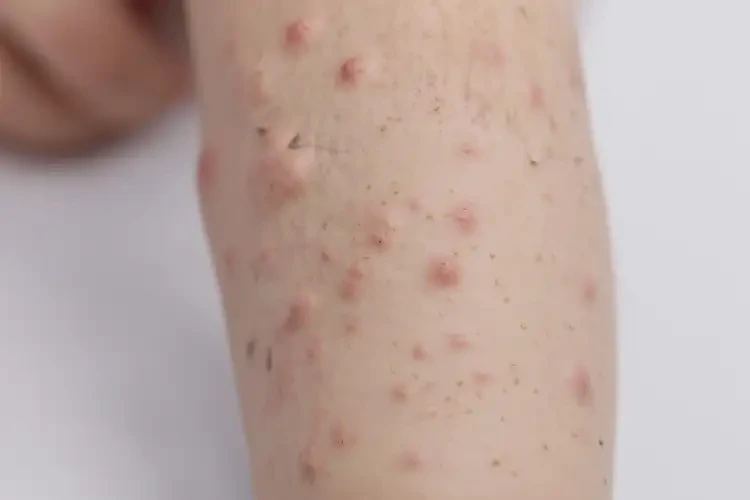 少兒四肢起濕疹不管它會自己痊愈嗎(圖4)