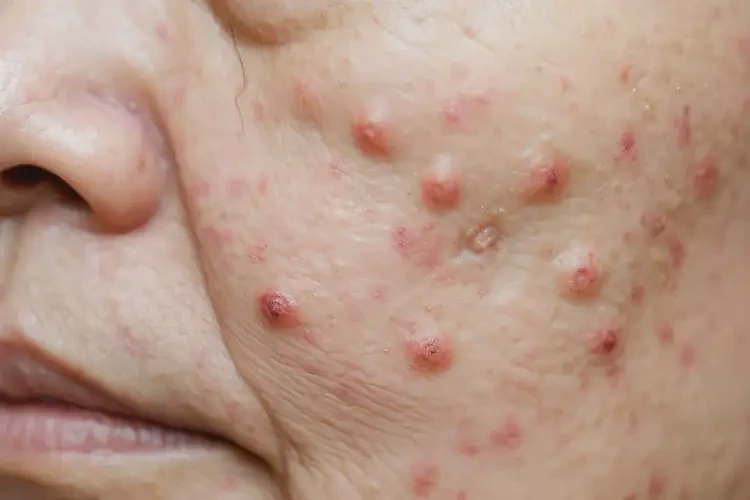 男人肛周起湿疹不管它会自己好吗(图4)