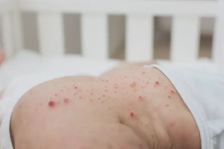 嬰兒脖子經(jīng)常長濕疹不管它會自己自愈嗎(圖4)