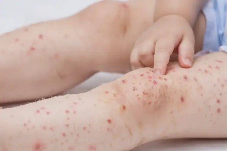 小孩四肢起濕疹能靠自己自愈嗎(圖4)