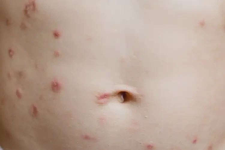 幼兒肚子上偶爾長濕疹能不能徹底自愈(圖4)