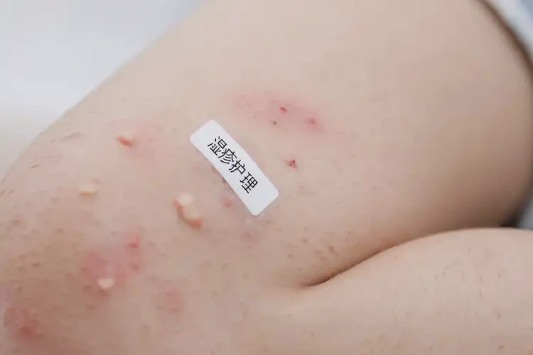 儿童大腿上偶尔起湿疹能靠自己自愈吗(图4)