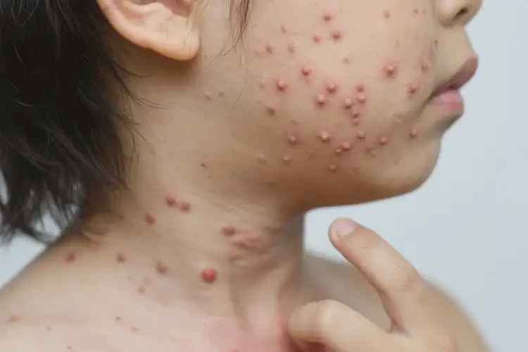 青少年脖子上容易起濕疹能夠徹底治愈嗎(圖4)