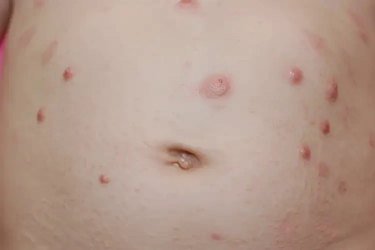 幼兒肚子上偶爾長濕疹能不能徹底自愈(圖3)