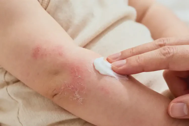 新生兒手臂上經(jīng)常起濕疹能徹底自愈嗎(圖2)