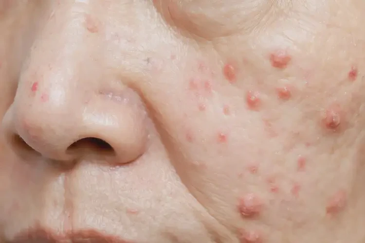 女人面部经常长湿疹能彻底自愈吗(图4)